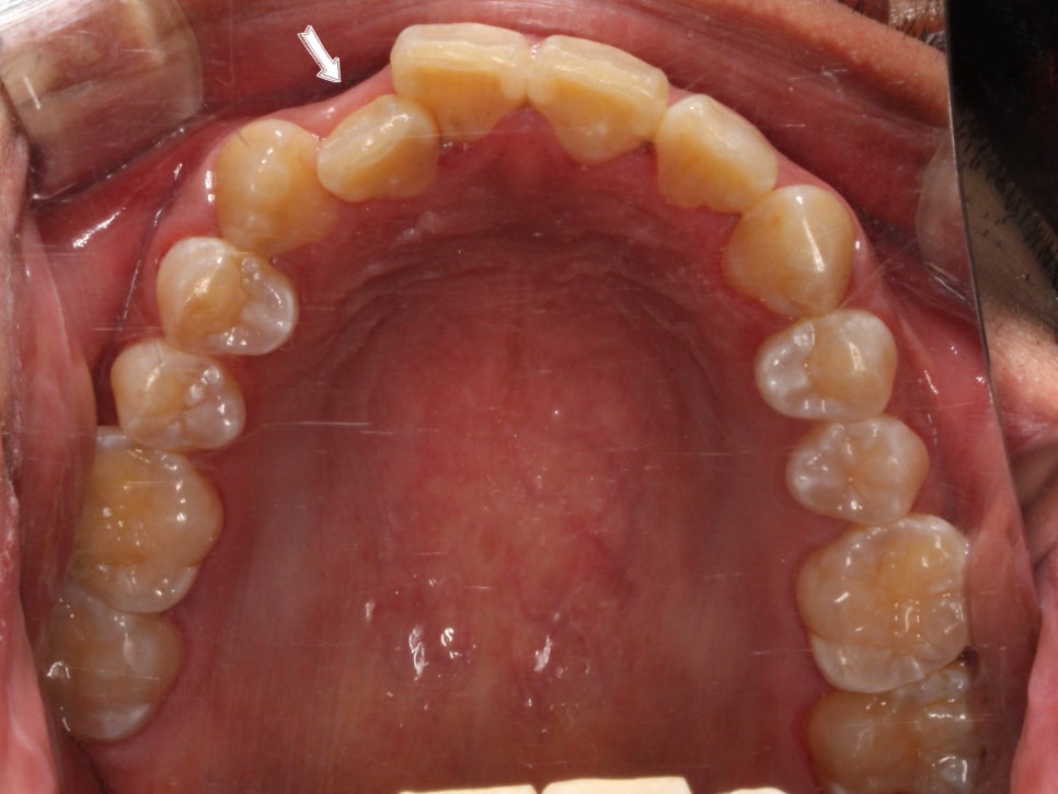 앞니 덧니 고민, 부분 설측 교정으로 해결한 사례 관련 이미지 3