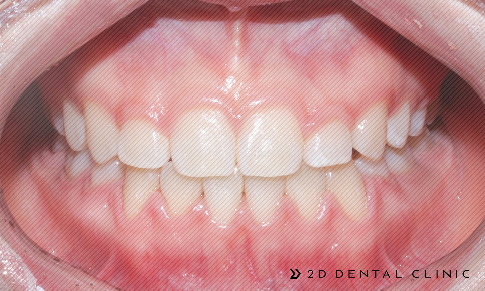 절단교합 교정 케이스 전후비교, 교정전문 2D치과 관련 이미지 7