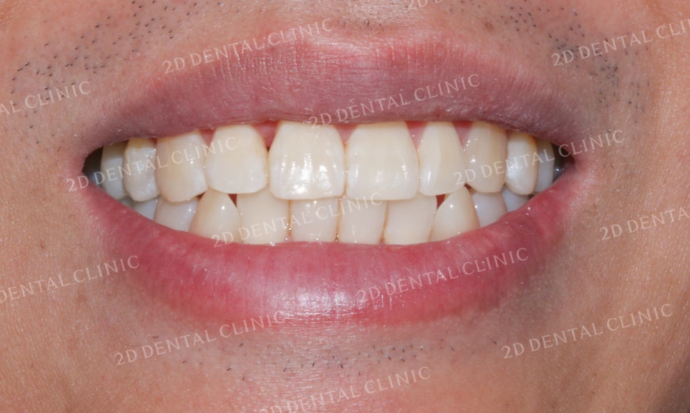 [앞니교정]부정교합교정, 부분교정으로 완성하기! by.투디치과(2D치과) 관련 이미지 10