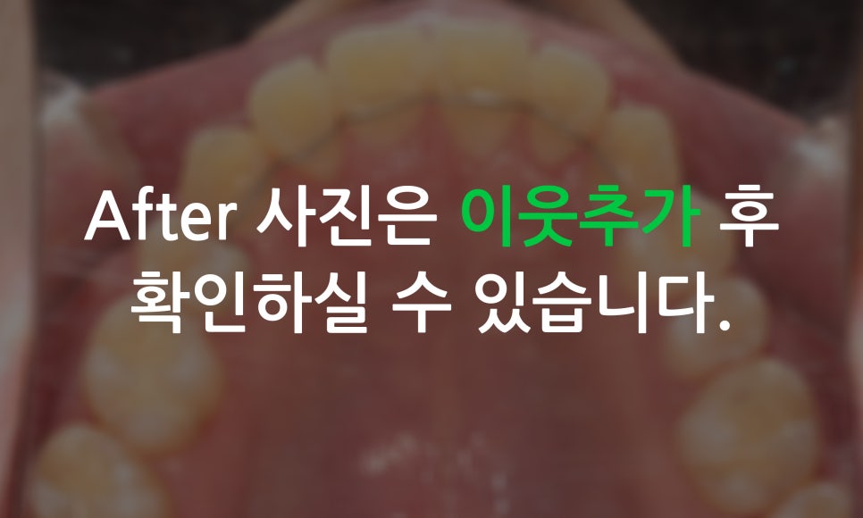 송곳니덧니가 있을 때 교정하는 방법! 관련 이미지 7