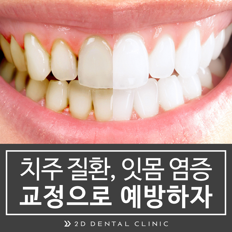 치주질환, 잇몸염증, 교정으로 예방하자! 관련 이미지 1