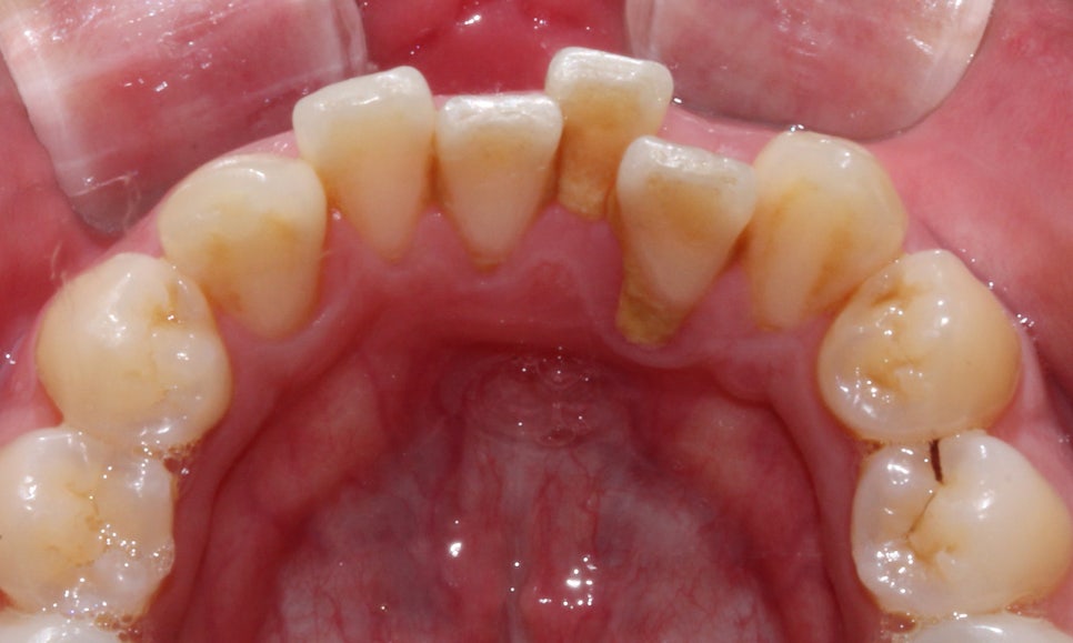 뻐드렁니 교정, 강남역치과에서 앞니 부분 교정한 후기! 관련 이미지 7