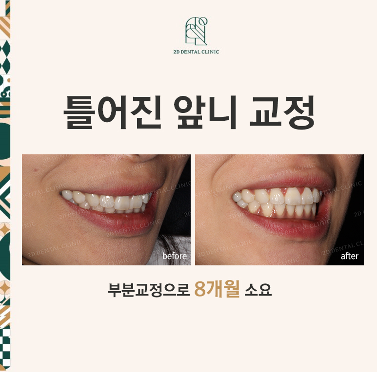 [부분교정] 틀어진 앞니, 부분교정으로 앞니교정하기! by.투디치과(2D치과) 관련 이미지 1