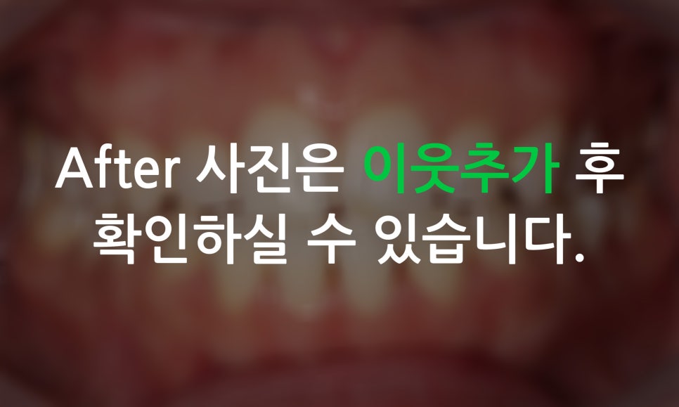 2D치과(투디치과)가 소개하는 토끼앞니 2D교정방법! 관련 이미지 8