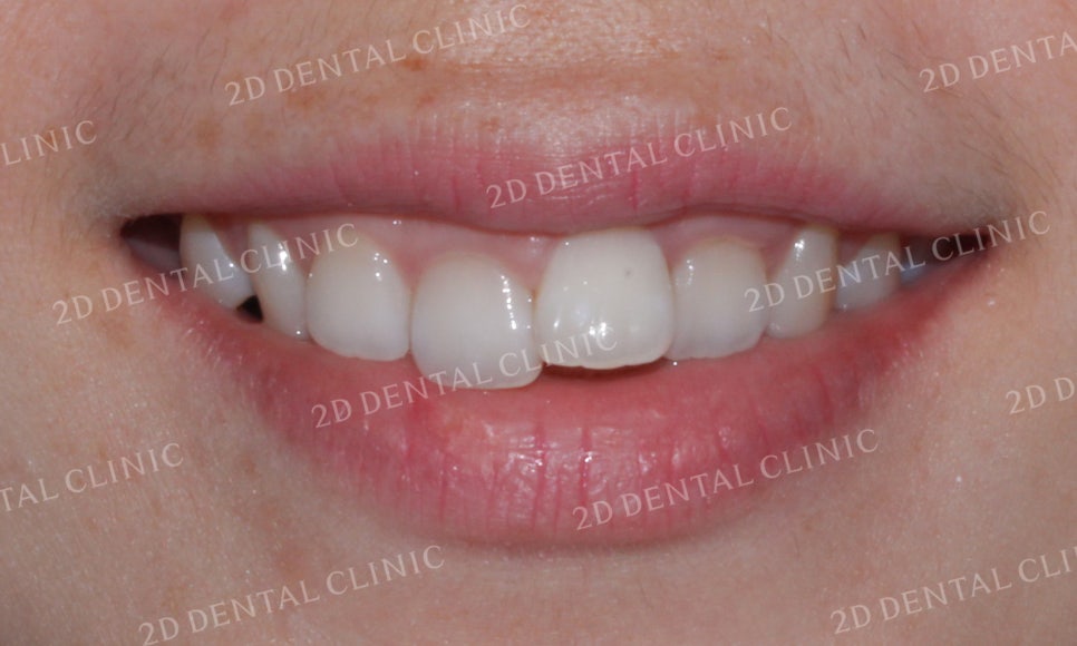 [투디교정] 덧니교정, 앞니교정으로 치열을 고르게! by.투디치과(2D치과) 관련 이미지 9