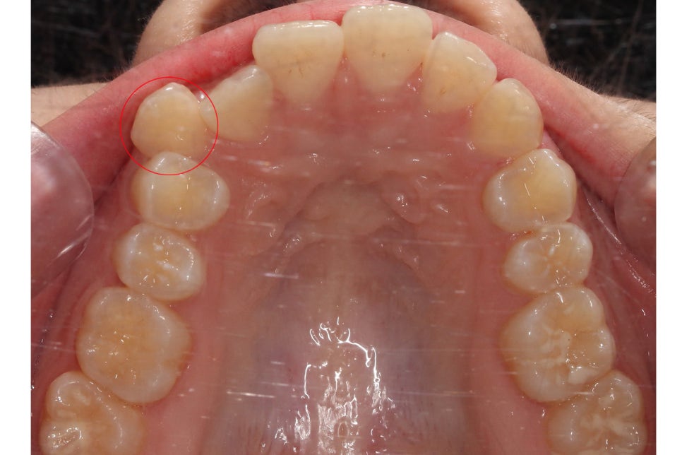 투디치과 송곳니덧니 치료 후기 관련 이미지 6