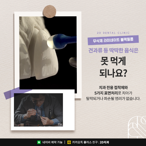 앞니 라미네이트 블랙필름의 효과성 A to Z 관련 이미지 6