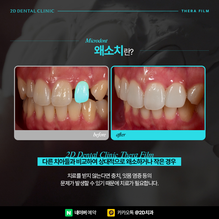 왜소치 세라필름, 원데이라미네이트로 해결하기 위해서는 강남역 치과 관련 이미지 2