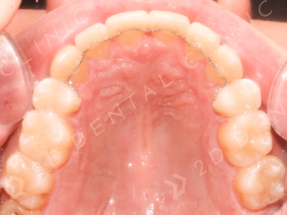 덧니만 부분교정으로 교정 할 수 있나요? 관련 이미지 4