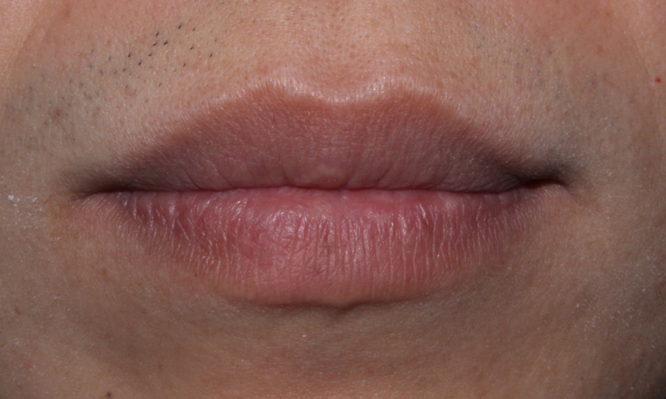 뻐드렁니 교정, 강남역치과에서 앞니 부분 교정한 후기! 관련 이미지 8