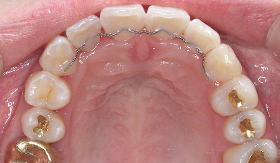 2D치과 2D교정으로 4개월만에 덧니 개선! 관련 이미지 12