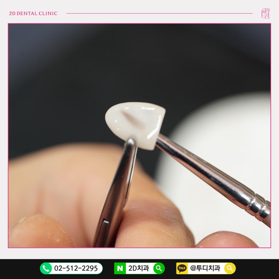 앞니가 깨졌을 때 치료방법은? 관련 이미지 5