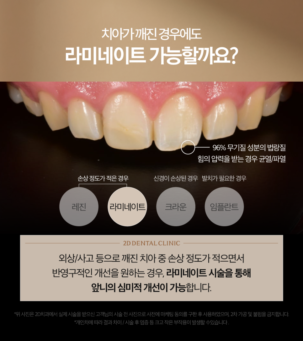 대구무삭제라미네이트 앞니깨짐 보완하며 자연스러움은 그대로! 관련 이미지 3