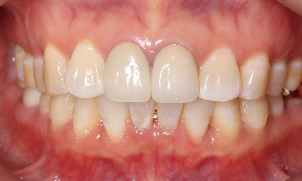 2D교정으로 아랫니 부분교정 빠르게 완성하기! 관련 이미지 6