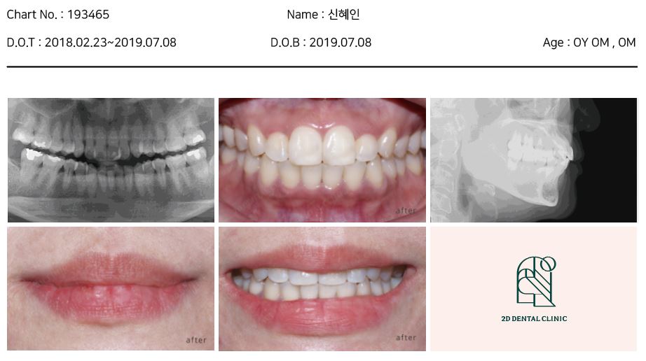 2D치과(투디치과) 교정일기ㅣ앞니덧니,반대교합 치아교정 완료!(ft.투디교정 전체교정) 관련 이미지 17