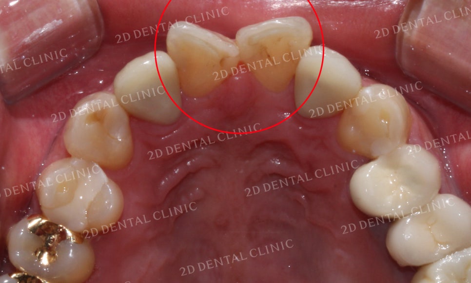 [2D교정] 나비치아교정을 2D교정 장치로 빠르게 완성하기! by.2D치과(투디치과) 관련 이미지 6