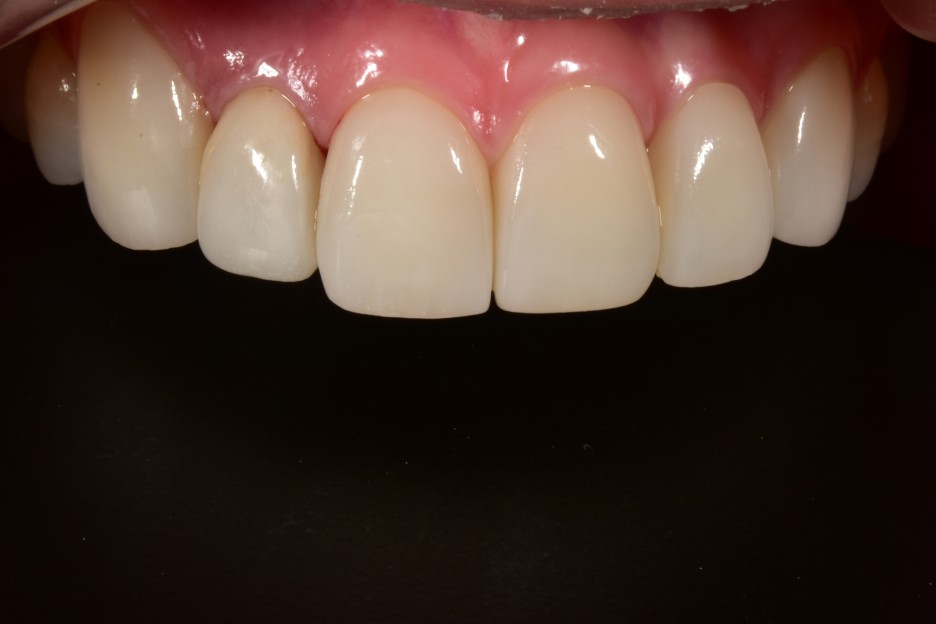 [투디치과] 블랙필름(비스포크) 치료의 다양한 사례 관련 이미지 30