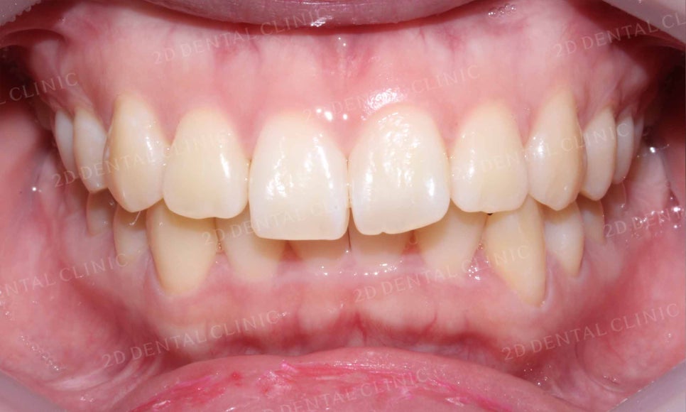 강남역 치과에서 앞니부분 설측 2D(투디)교정으로 토끼앞니 탈출한 후기 관련 이미지 5
