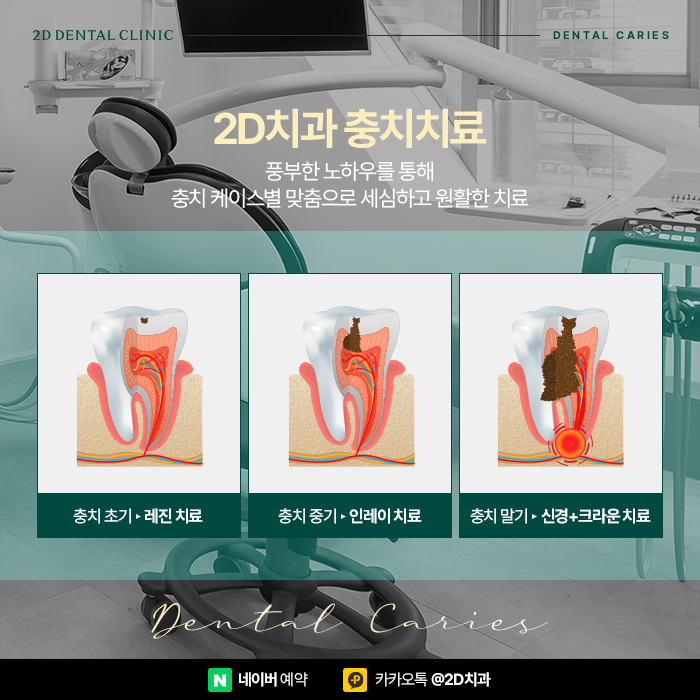 충치통증? 2D치과의 충치치료로 역삼동치과 관련 이미지 4