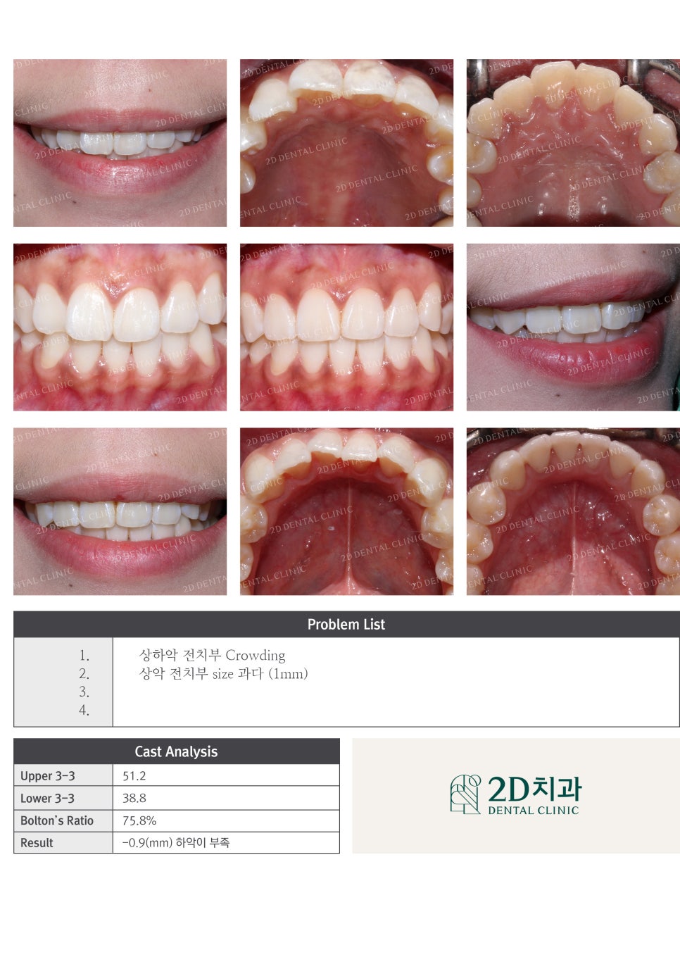 돌출입, 돌출앞니를 부분교정으로 고르게! by.투디치과(2D치과) 관련 이미지 5