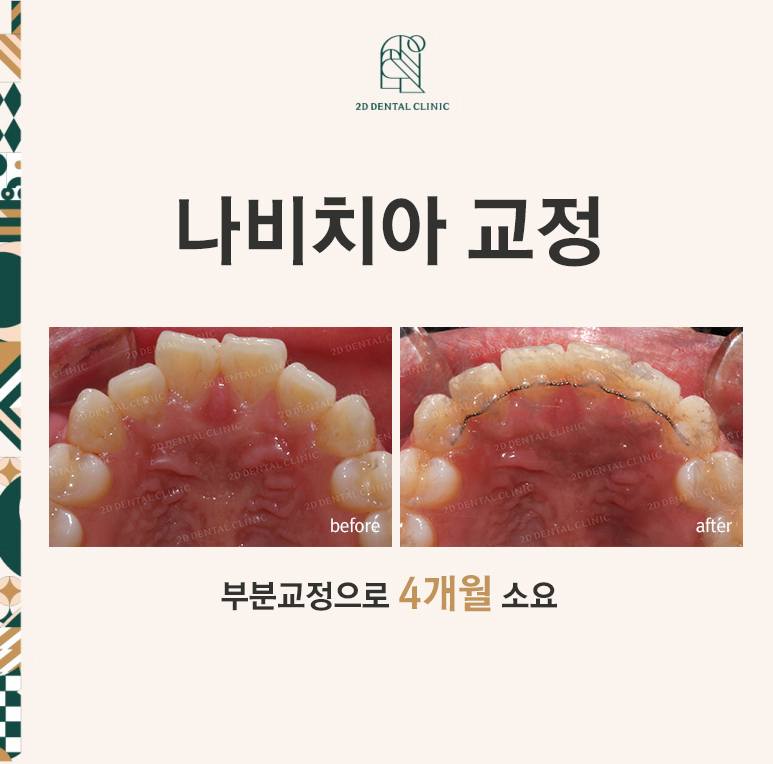 [2D교정] 나비치아, 앞니교정 설측교정으로 빠르게 하는 방법! by.2D치과(투디치과) 관련 이미지 1