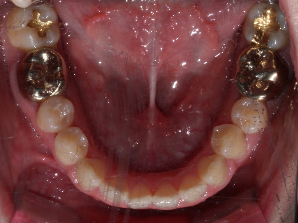 덧니 투명교정 8개월 치료 사례 관련 이미지 8