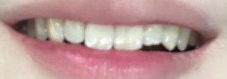 무삭제라미네이트 치아삭제없는 0.1mm 얇은 블랙필름 관련 이미지 2