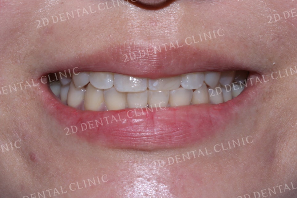 반대교합으로 물리는 치아를 바른 교합으로 교정하기! by.투디치과(2D치과) 관련 이미지 9