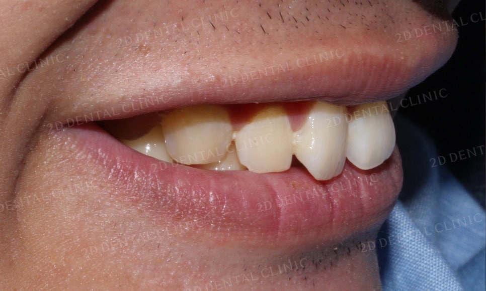 [앞니교정] 벌어진 앞니, 부분교정으로 앞니교정하기! by.2D치과(투디치과) 관련 이미지 4