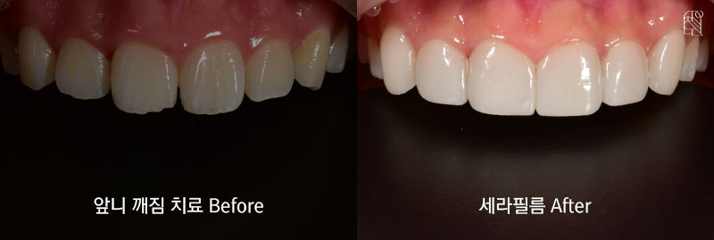 앞니가 깨졌을 때 치료방법은? 관련 이미지 6