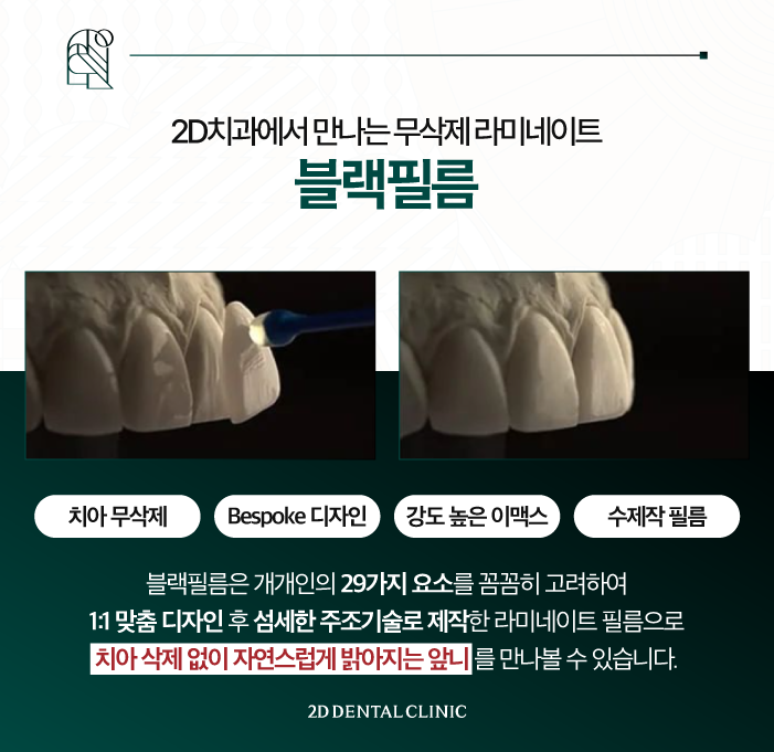 무삭제라미네이트부작용 가격 확인해 보자! 관련 이미지 4