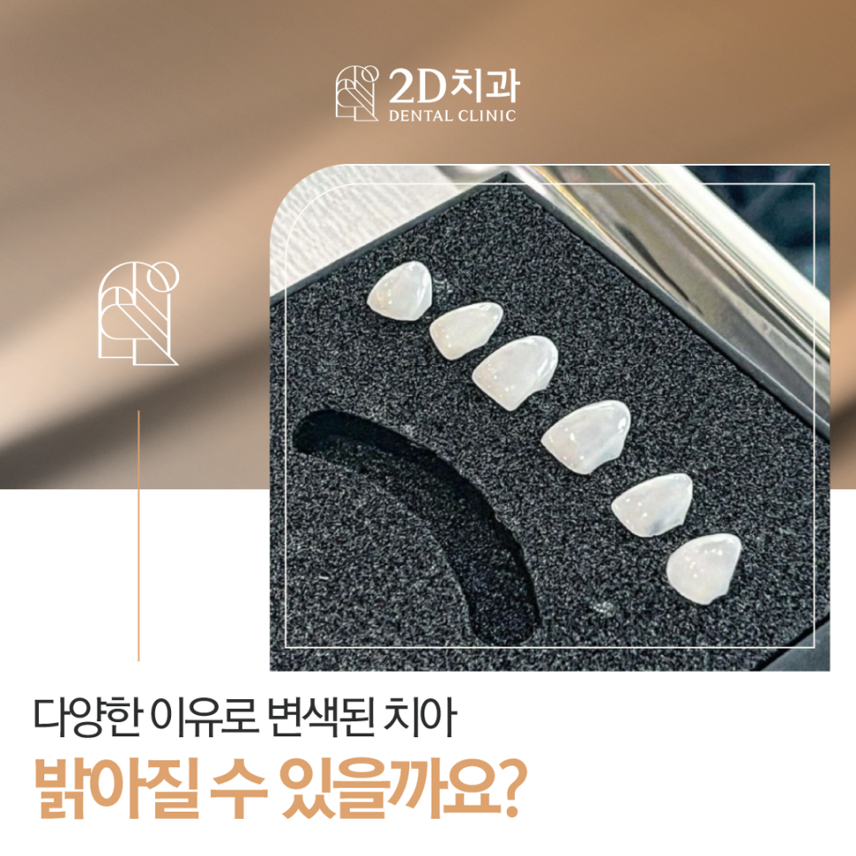 무삭제라미네이트 치아변색 블랙필름으로 화사해진 이 관련 이미지 1