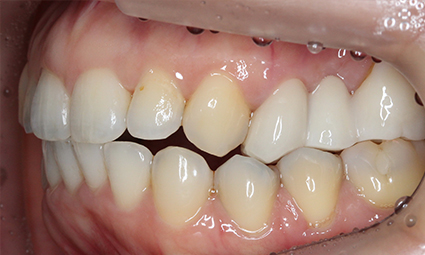 앞니틀어짐 부분교정 완성 후기 관련 이미지 11