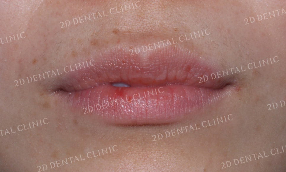 [투디교정] 덧니교정, 앞니교정으로 치열을 고르게! by.투디치과(2D치과) 관련 이미지 8