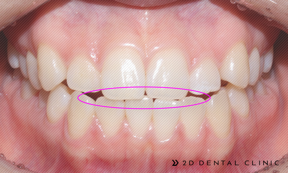 절단교합 교정 케이스 전후비교, 교정전문 2D치과 관련 이미지 4