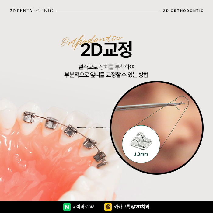 고른 앞니 치아모양을 위한 반포역 2D교정 관련 이미지 2