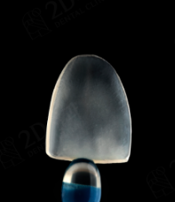 앞니왜소치 치아깨짐 무삭제라미네이트 블랙필름 관련 이미지 7