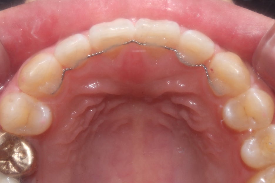 벌어진앞니 치간이개 공간 삭제하기! 관련 이미지 9