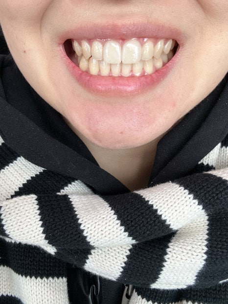 무삭제라미네이트 블랙필름 케이스 비포 에프터 후기 관련 이미지 9