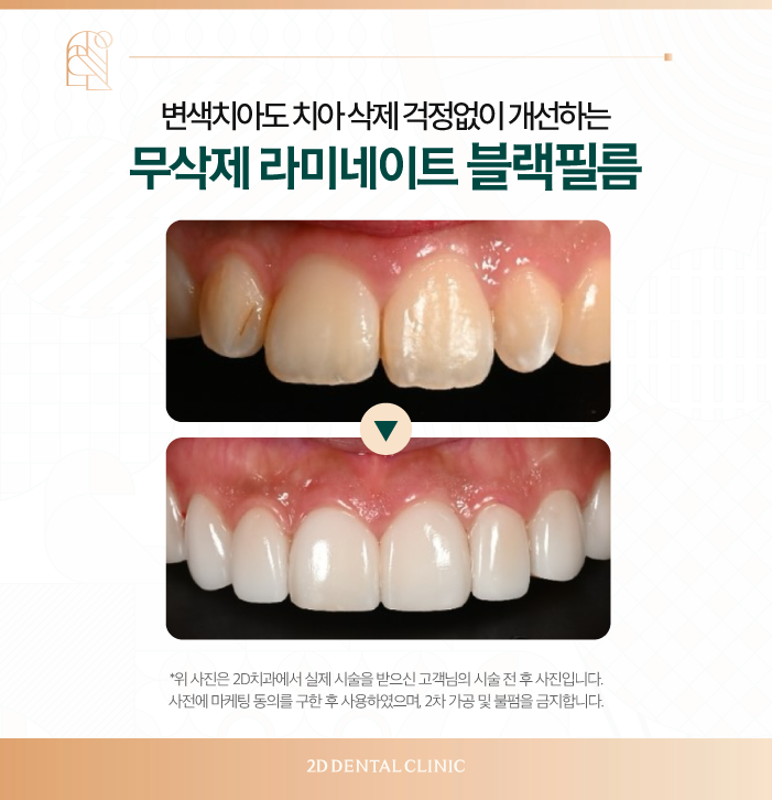 무삭제라미네이트비용 2D치과 변색치아를 하얗게! 관련 이미지 6