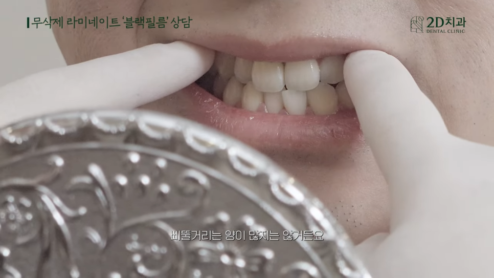 [블랙필름 상담받고 왔어요] #2 반대교합도 가능할까요? 관련 이미지 6