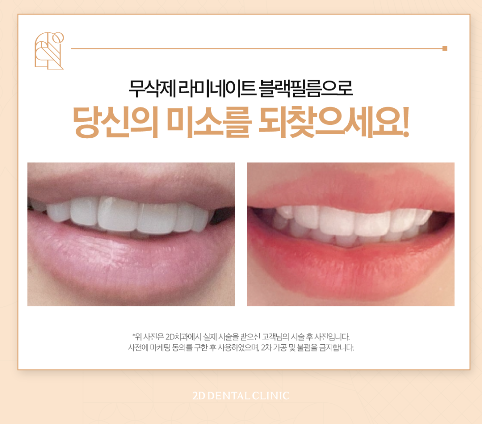 서초치과 치아변색치료 미백도 블랙필름으로 관련 이미지 6