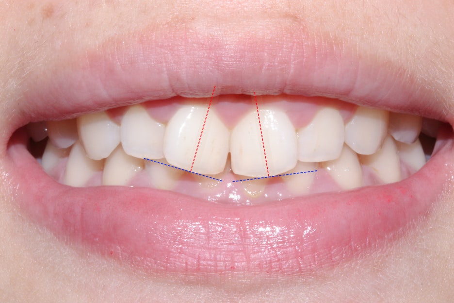 옥니교정 방법! 세라믹교정 Case 관련 이미지 1