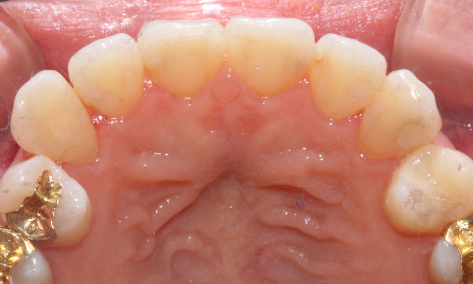 토끼 이빨 치아교정 5개월 교정 완료! by. 투디치과(2D치과) 관련 이미지 9