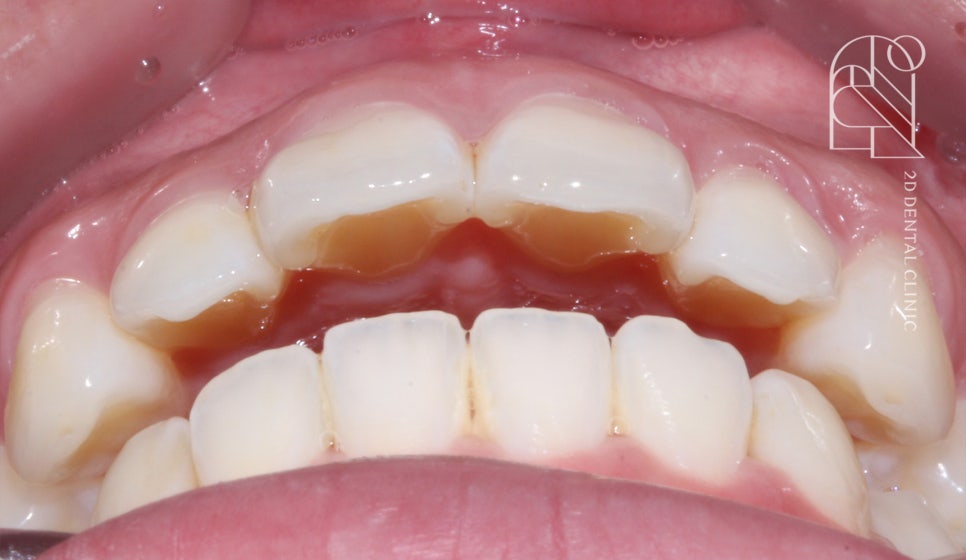 부정교합 치아교정, 전체교정으로 완성하기! by. 투디치과(2D치과) 관련 이미지 3