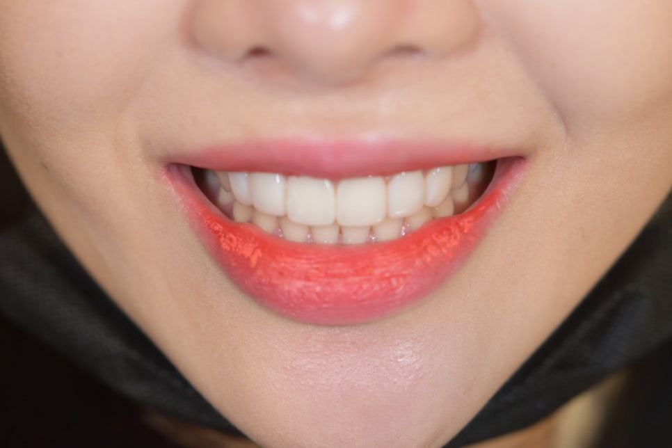 라미네이트치과 알아본다면? 관련 이미지 3