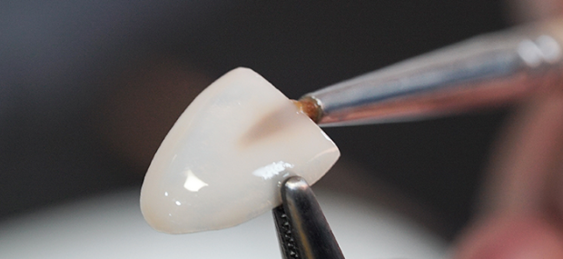 라미네이트잘하는곳 무삭제라미 블랙필름 2D치과 관련 이미지 8