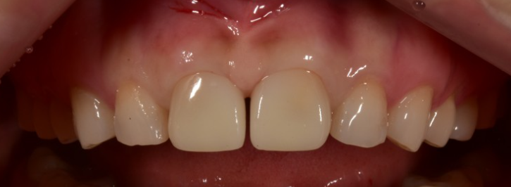 치아성형 잇몸성형 치아삭제 없는 무삭제라미네이트 블랙필름 관련 이미지 7