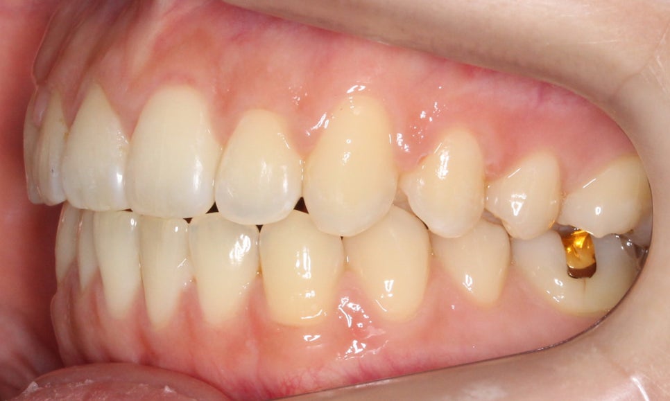 나비앞니 세라믹교정 case 관련 이미지 12