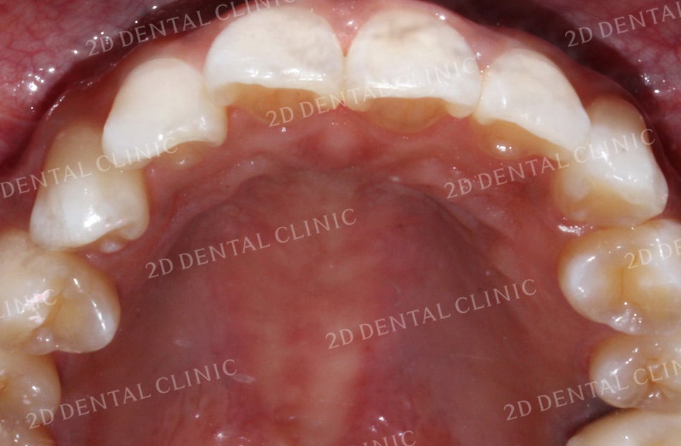 돌출입, 돌출앞니를 부분교정으로 고르게! by.투디치과(2D치과) 관련 이미지 3